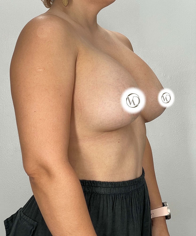 Breast Implant Exchange Before & After