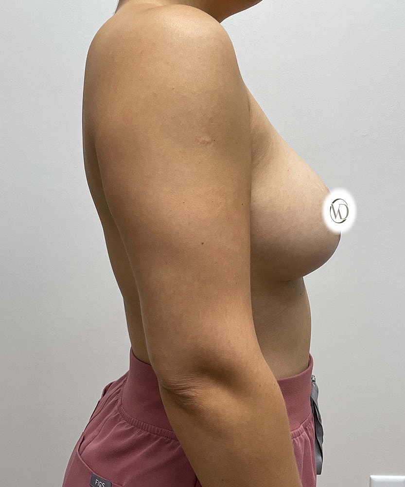 Breast Implant Exchange Before & After