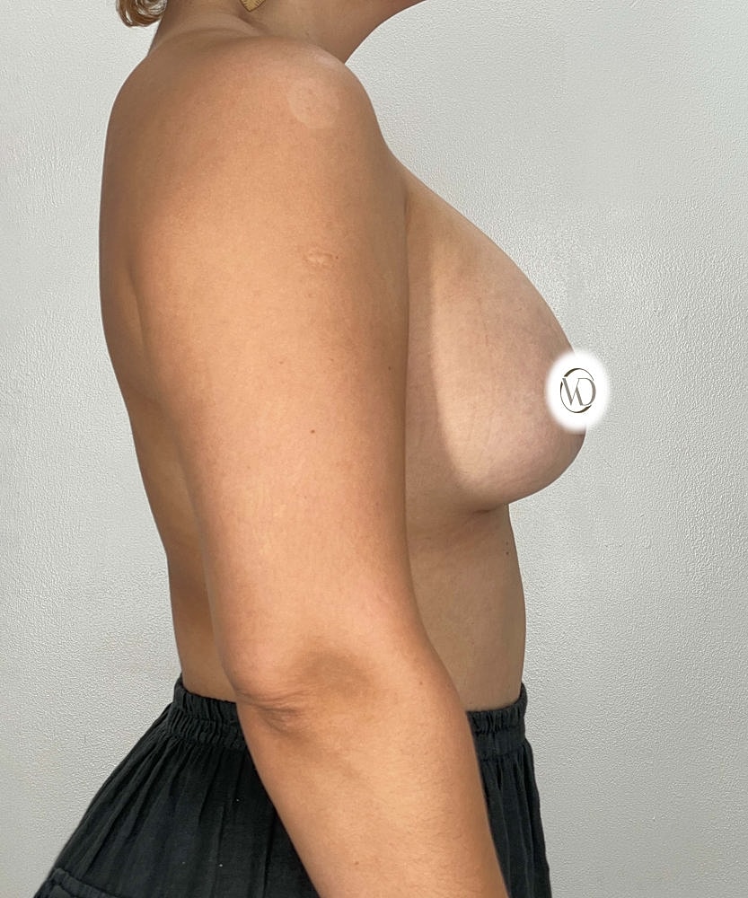 Breast Implant Exchange Before & After