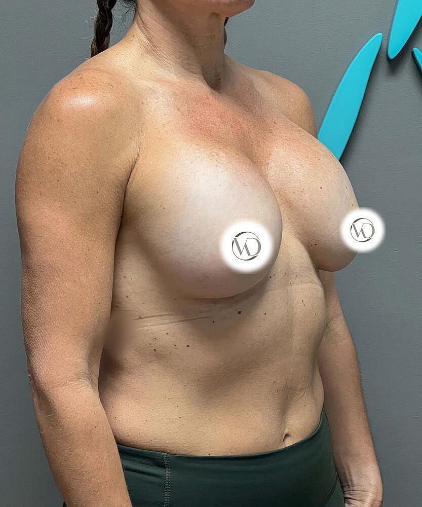 Breast Implant Exchange Before & After