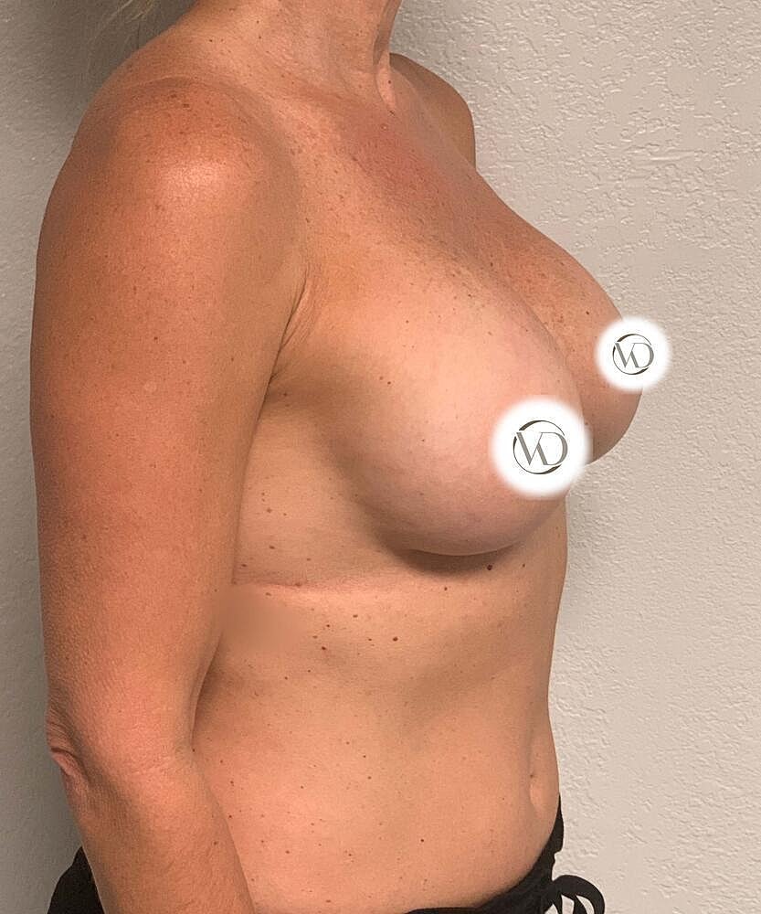 Breast Implant Exchange Before & After