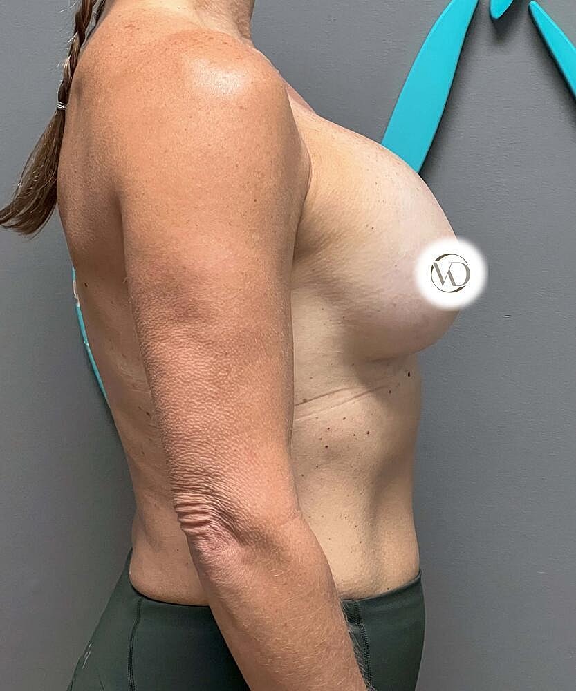 Breast Implant Exchange Before & After