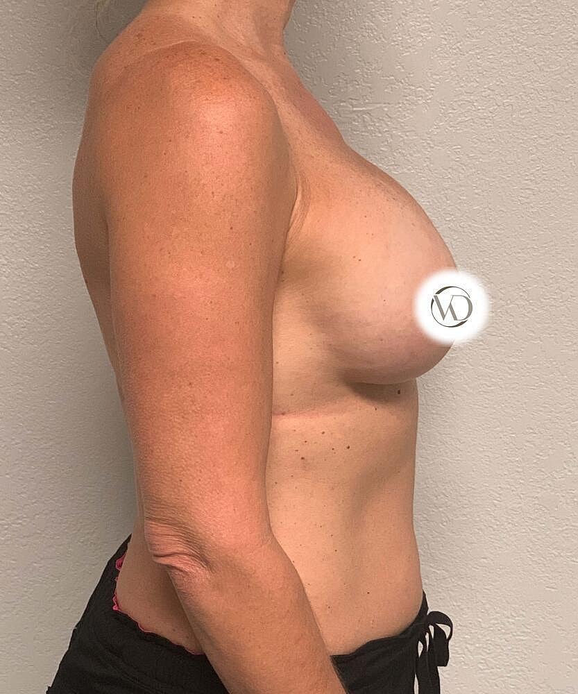 Breast Implant Exchange Before & After