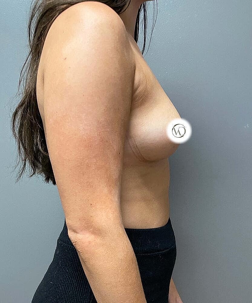 Breast Implant Exchange Gallery Before & After