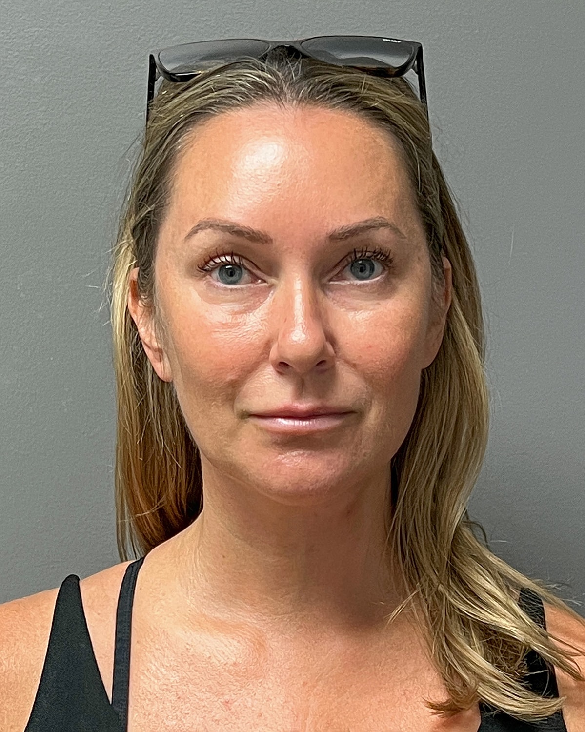 Neck Lift Gallery Before & After