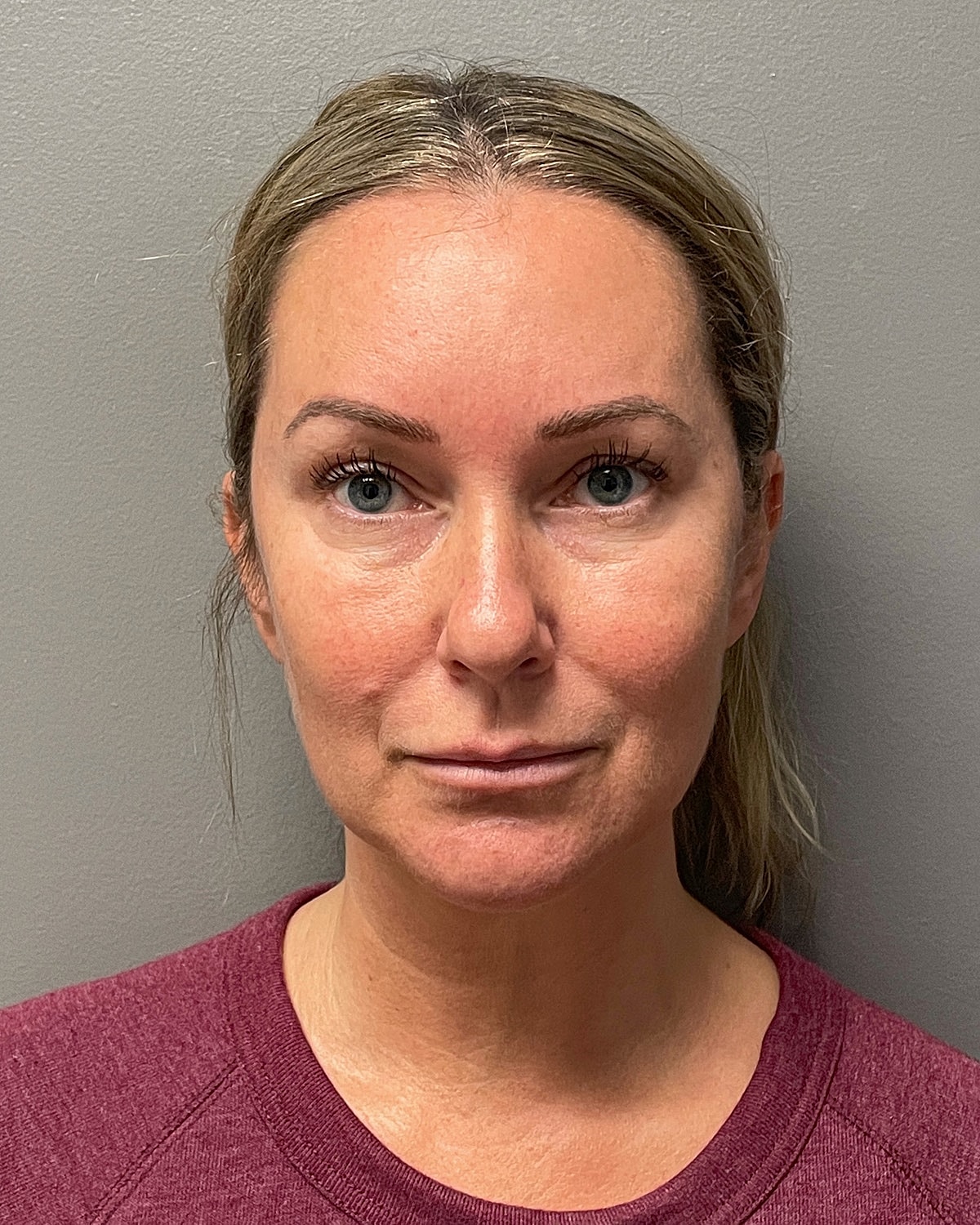 Neck Lift Gallery Before & After