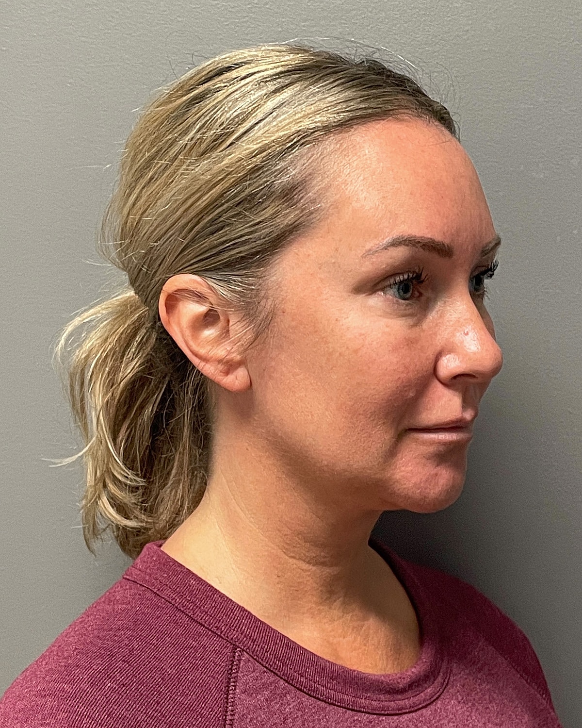 Neck Lift Gallery Before & After