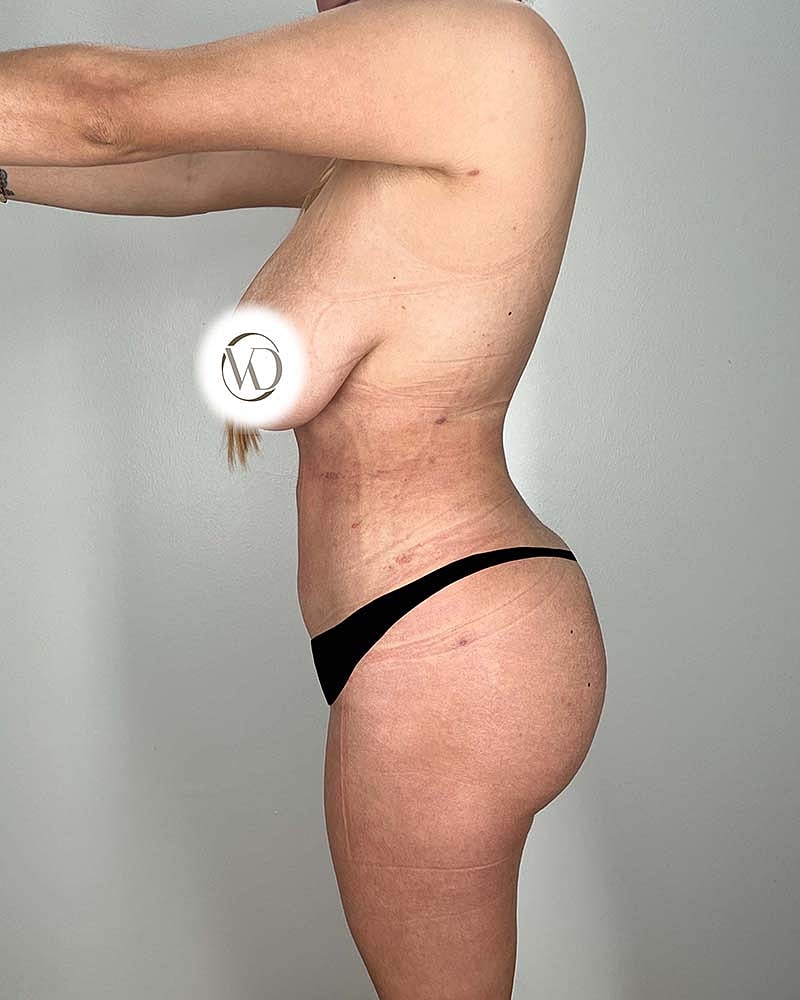 Brazilian Butt Lift Before & After
