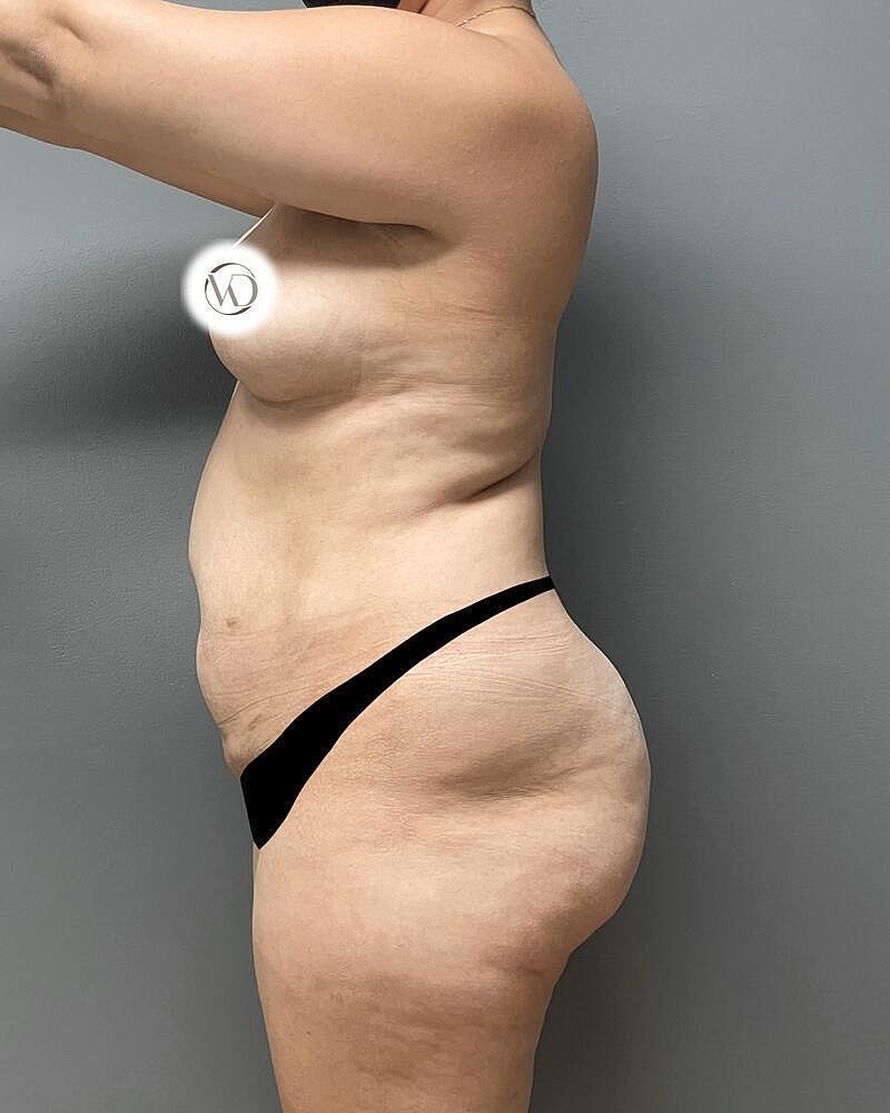 Brazilian Butt Lift Before & After