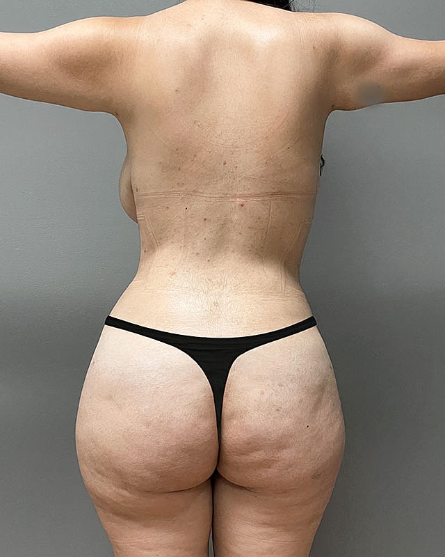 Brazilian Butt Lift Before & After