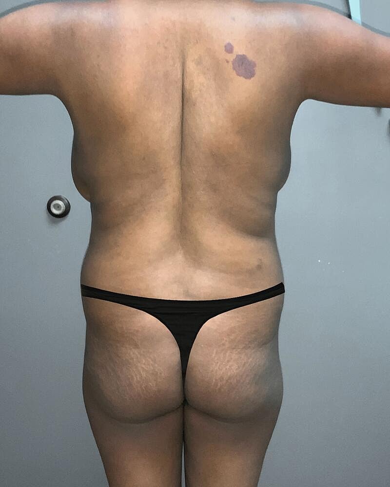 Brazilian Butt Lift Before & After