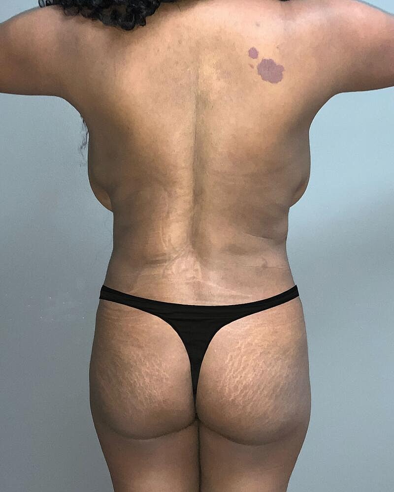 Brazilian Butt Lift Before & After