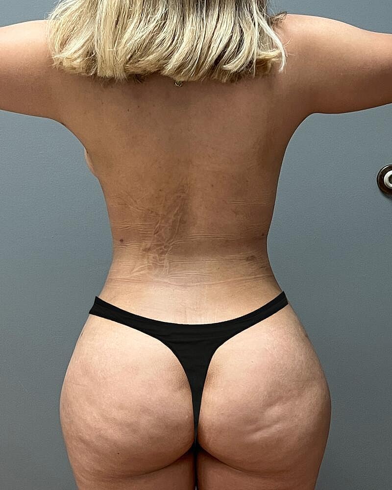 Brazilian Butt Lift Before & After