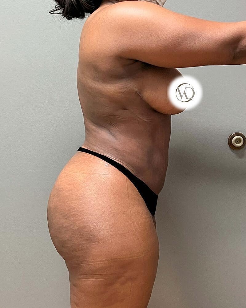 Brazilian Butt Lift Before & After