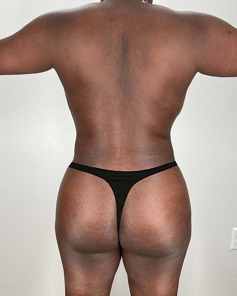 Brazilian Butt Lift Before & After