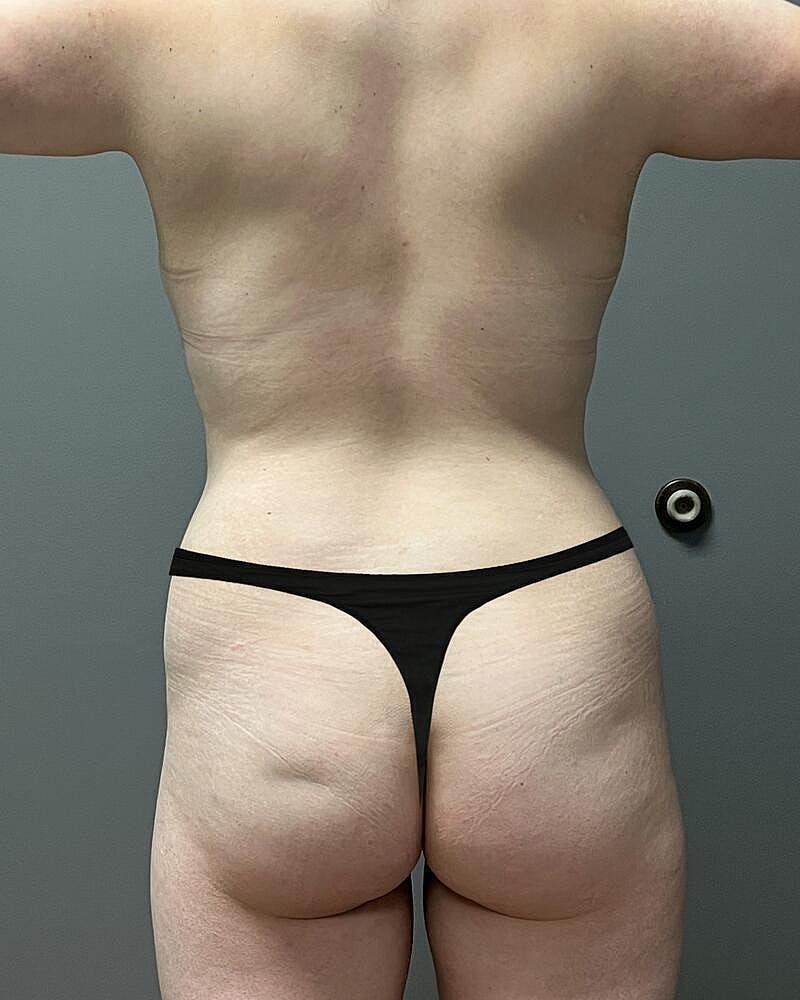 Brazilian Butt Lift Before & After