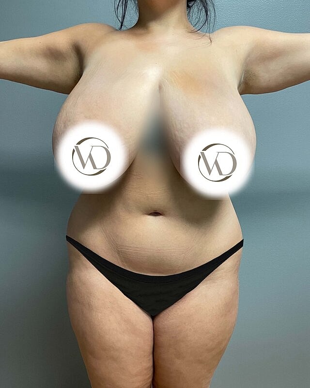 Brazilian Butt Lift Before & After