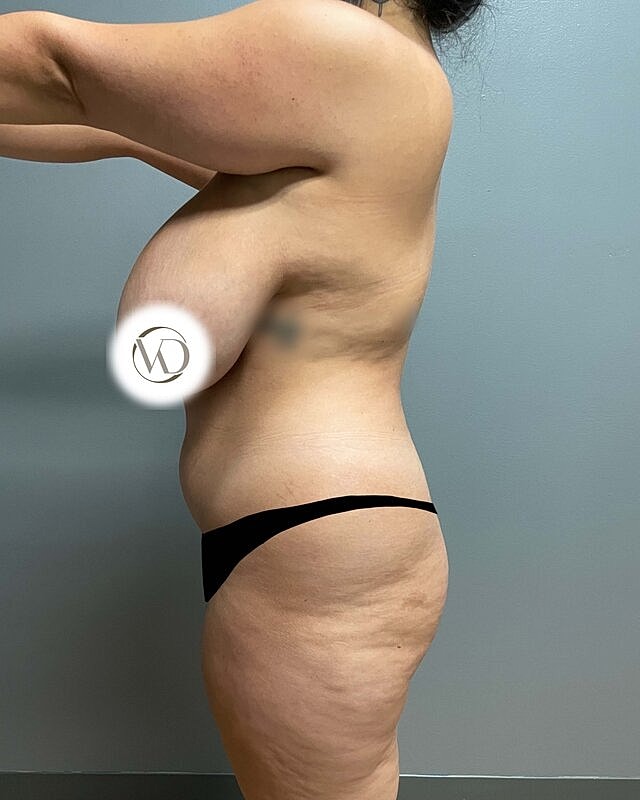 Brazilian Butt Lift Before & After