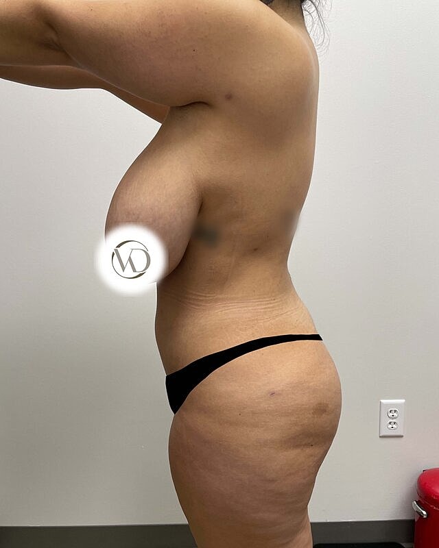 Brazilian Butt Lift Before & After