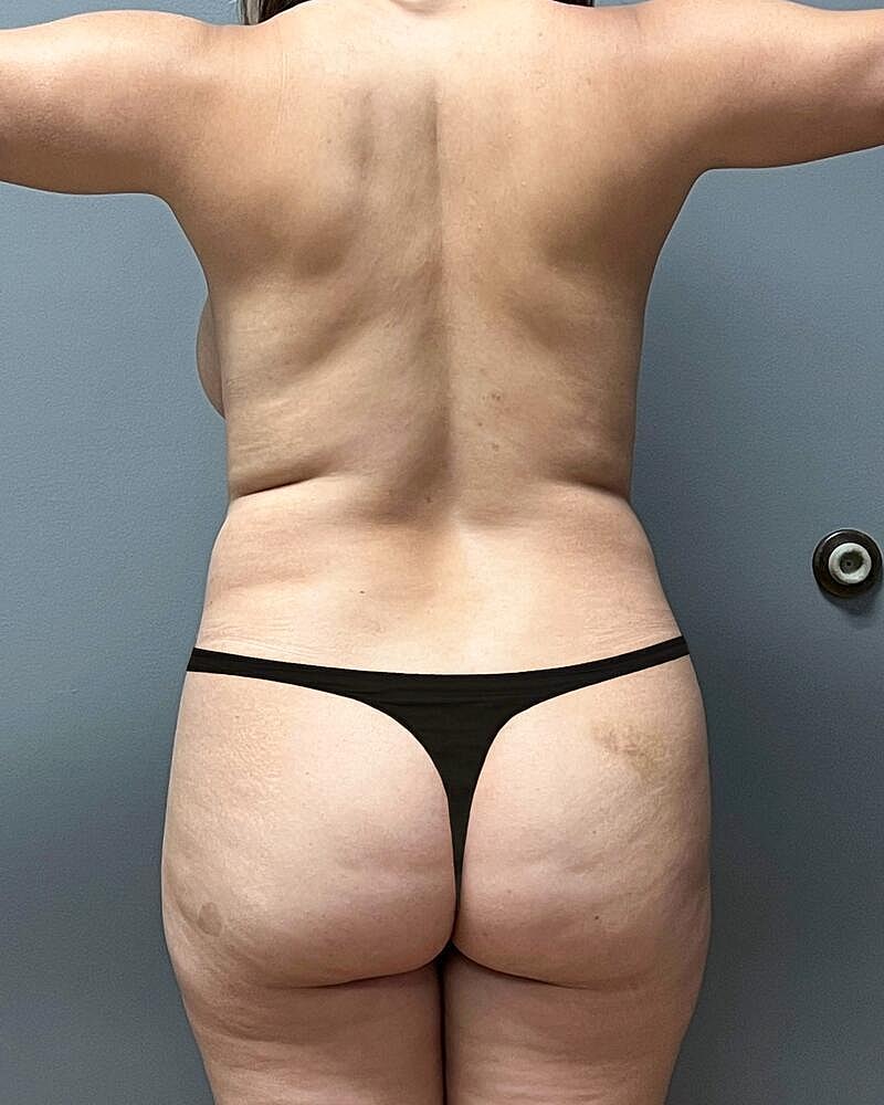 Brazilian Butt Lift Before & After