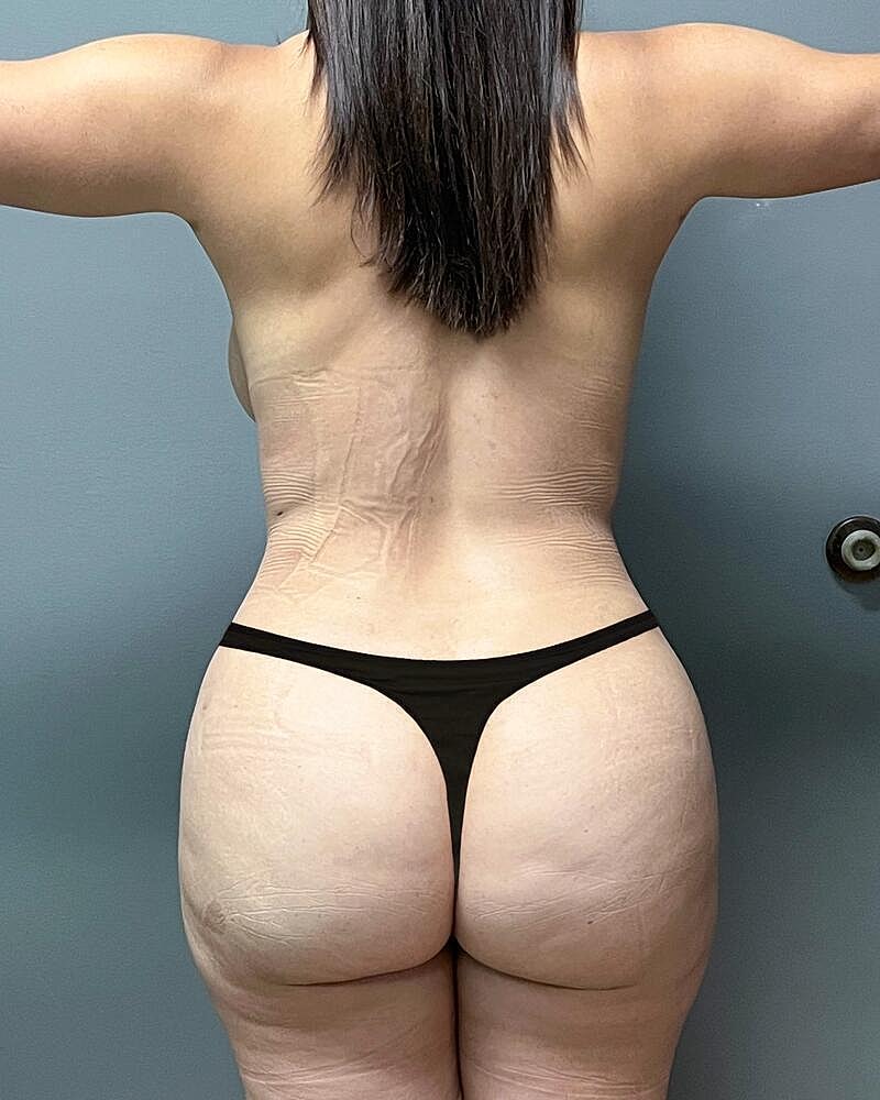 Brazilian Butt Lift Before & After