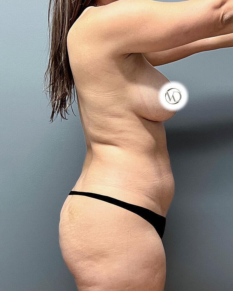 Brazilian Butt Lift Before & After