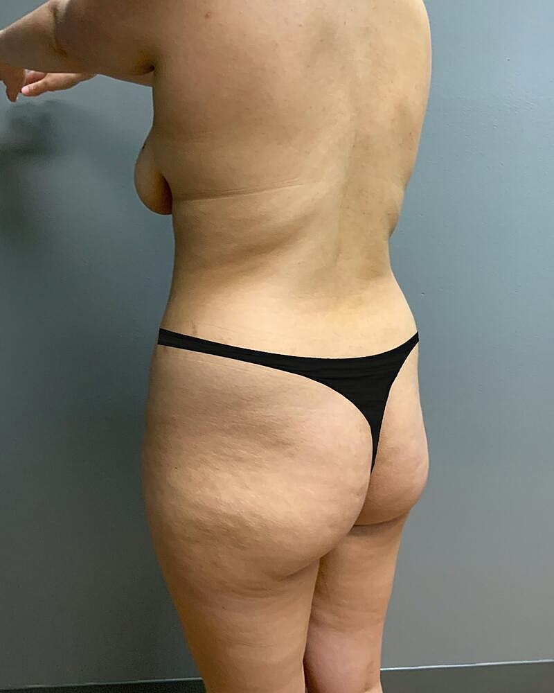 Brazilian Butt Lift Before & After