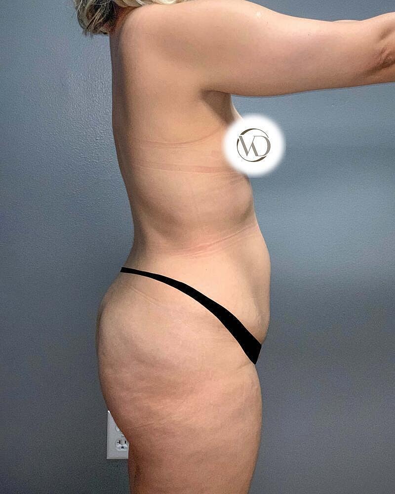 Brazilian Butt Lift Before & After