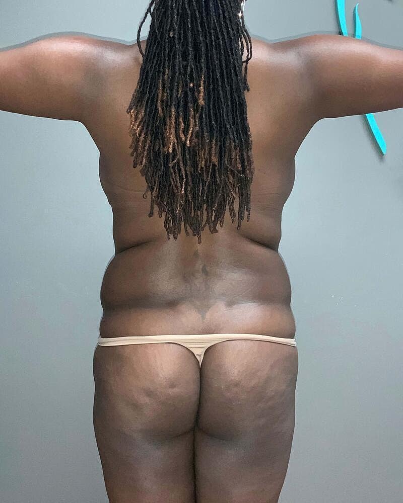 Brazilian Butt Lift Before & After