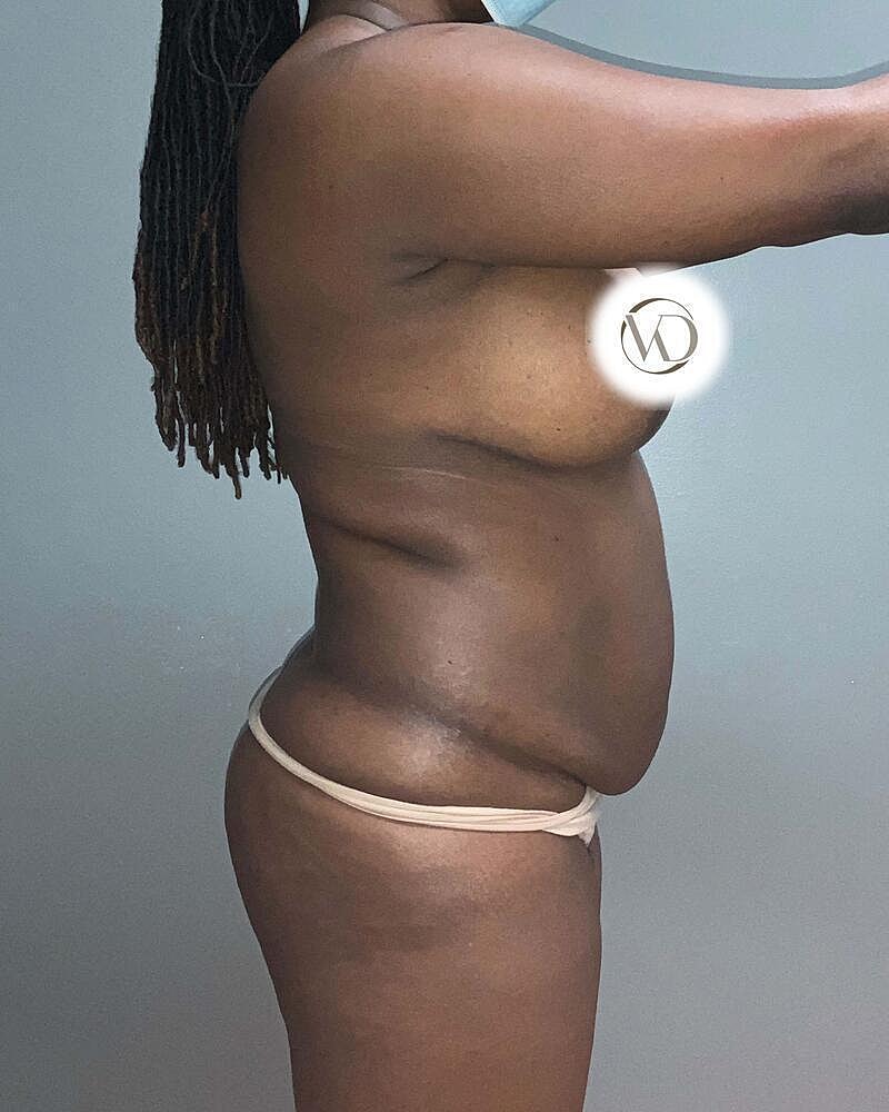 Brazilian Butt Lift Before & After