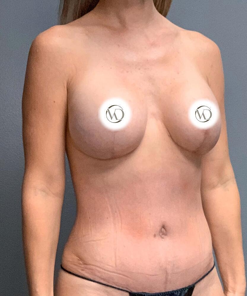 Breast Lift With Implant Exchange Before & After