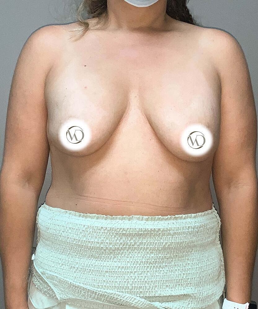 Breast Lift With Implant Exchange Before & After