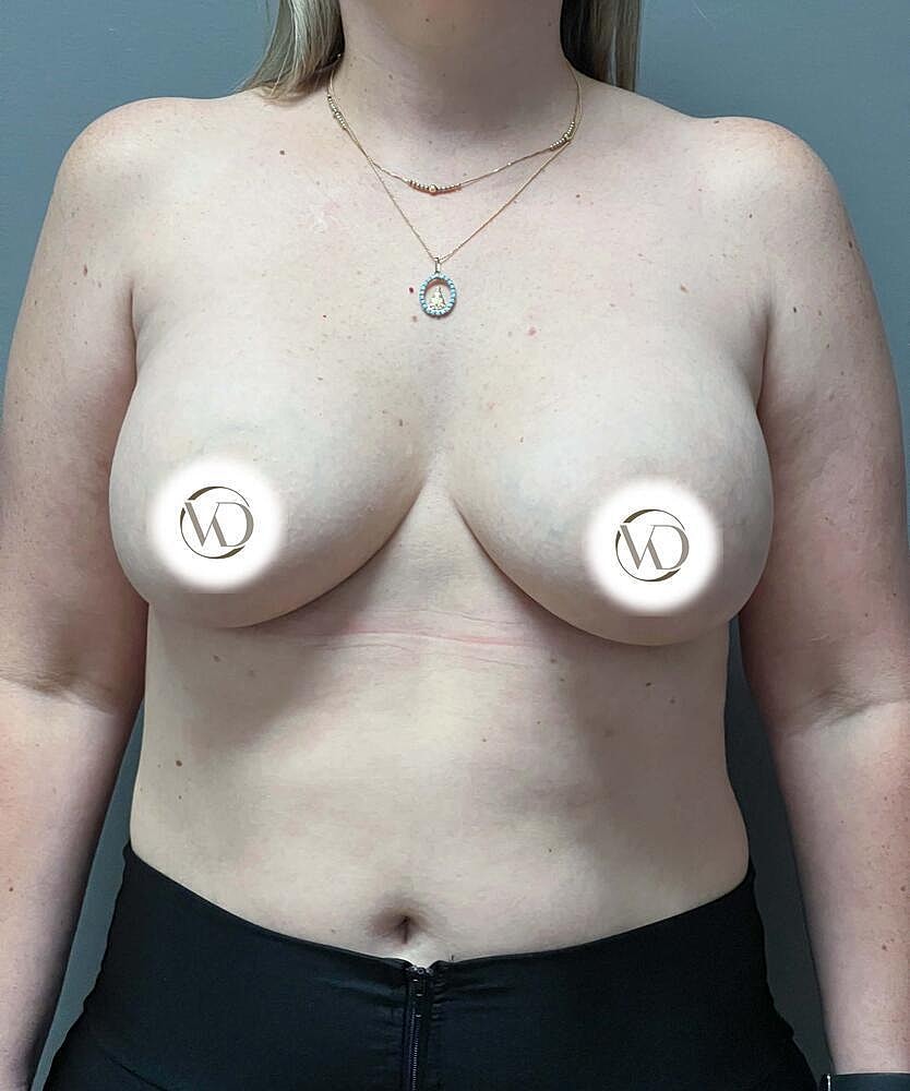 Breast Lift With Implant Exchange Before & After