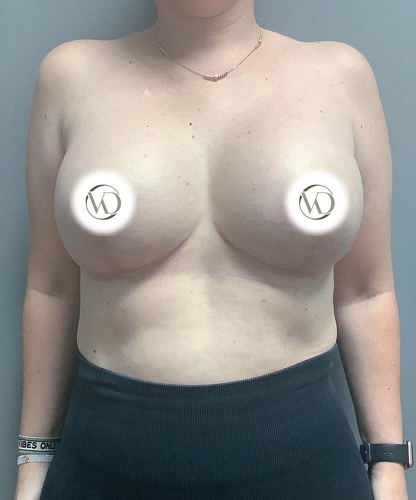 Breast Lift With Implant Exchange Before & After