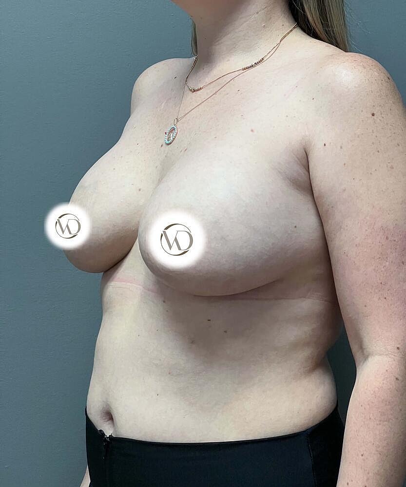 Breast Lift With Implant Exchange Before & After