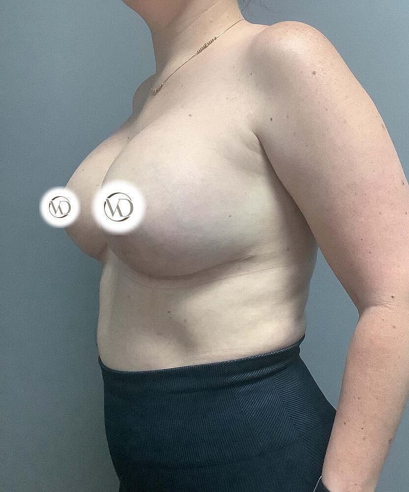 Breast Lift With Implant Exchange Before & After