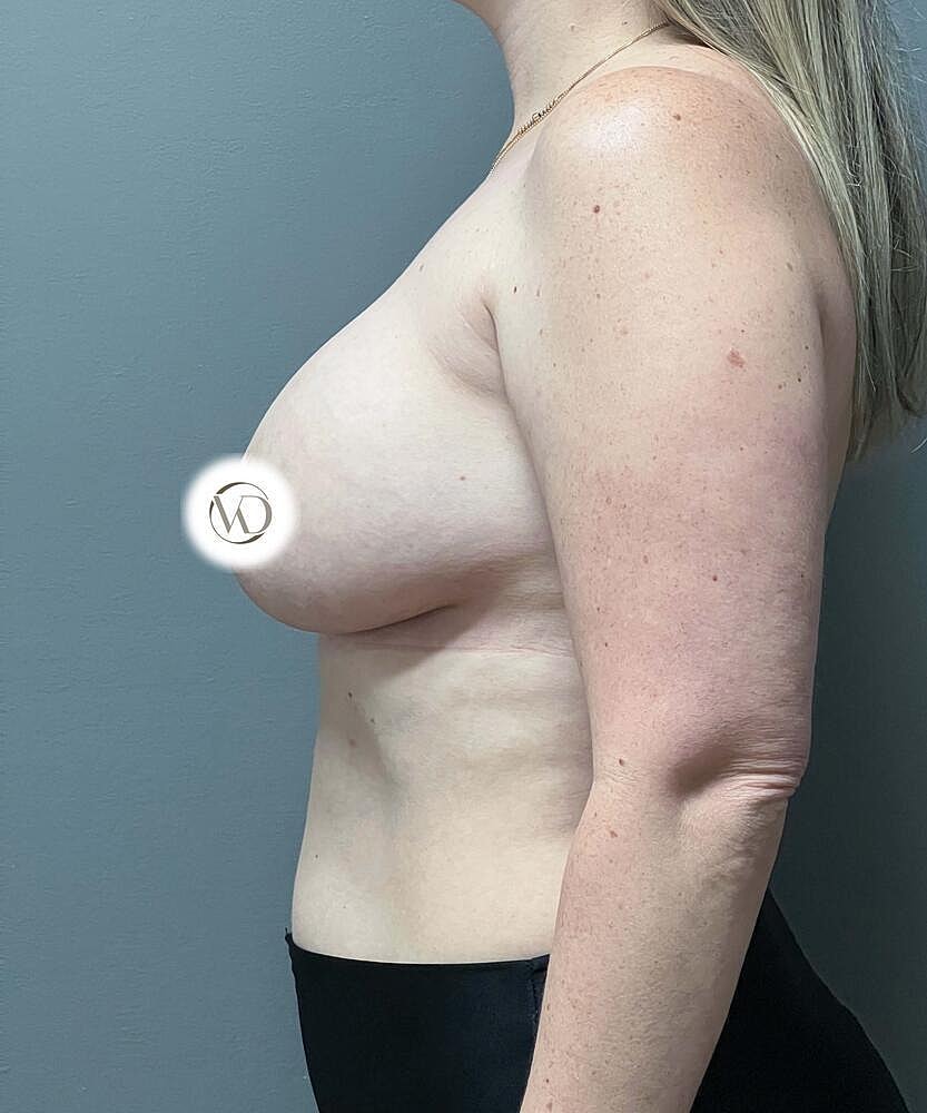 Breast Lift With Implant Exchange Before & After