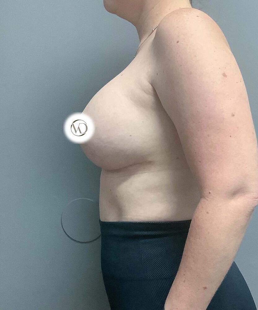 Breast Lift With Implant Exchange Before & After