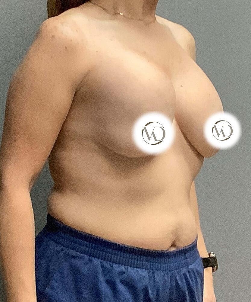 Breast Lift With Implant Exchange Before & After