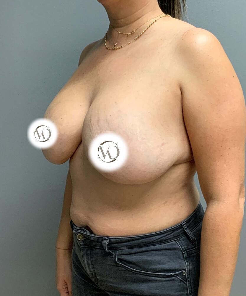 Breast Lift With Implant Exchange Before & After