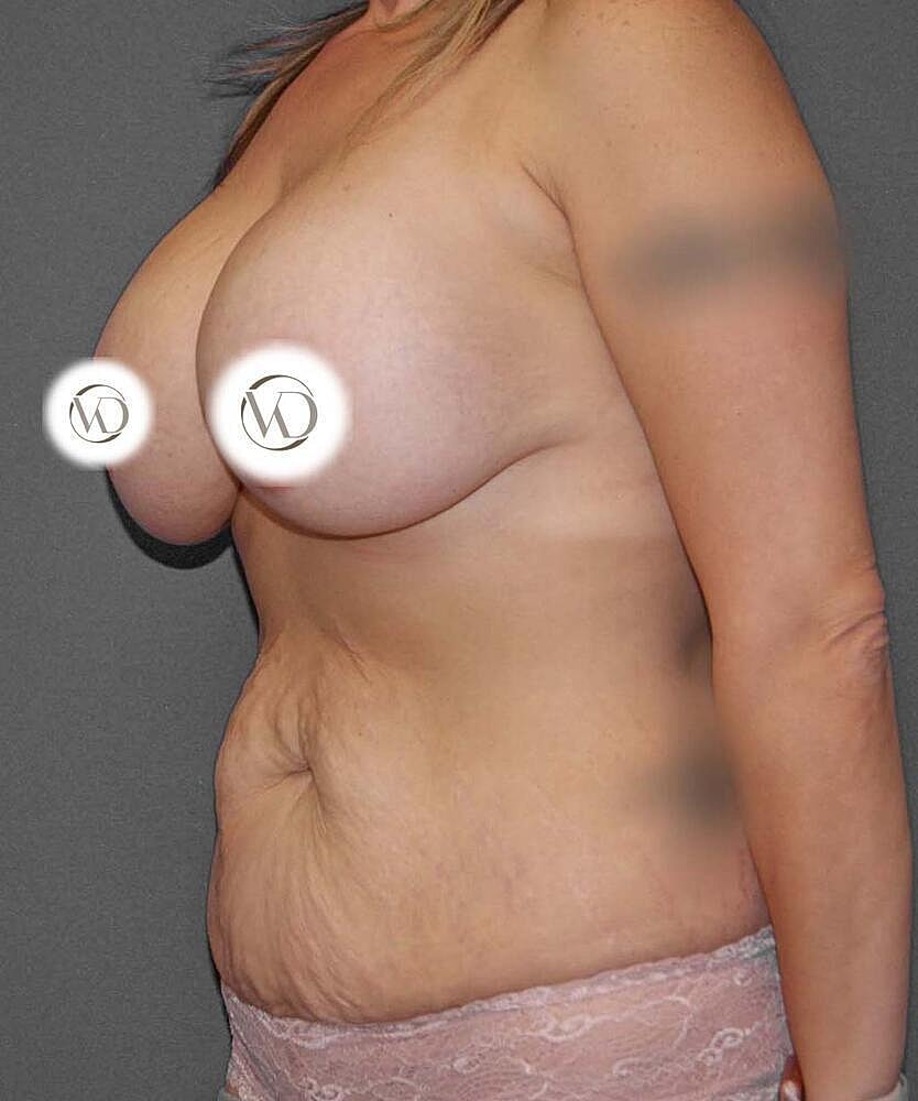 Breast Lift With Implant Exchange Before & After
