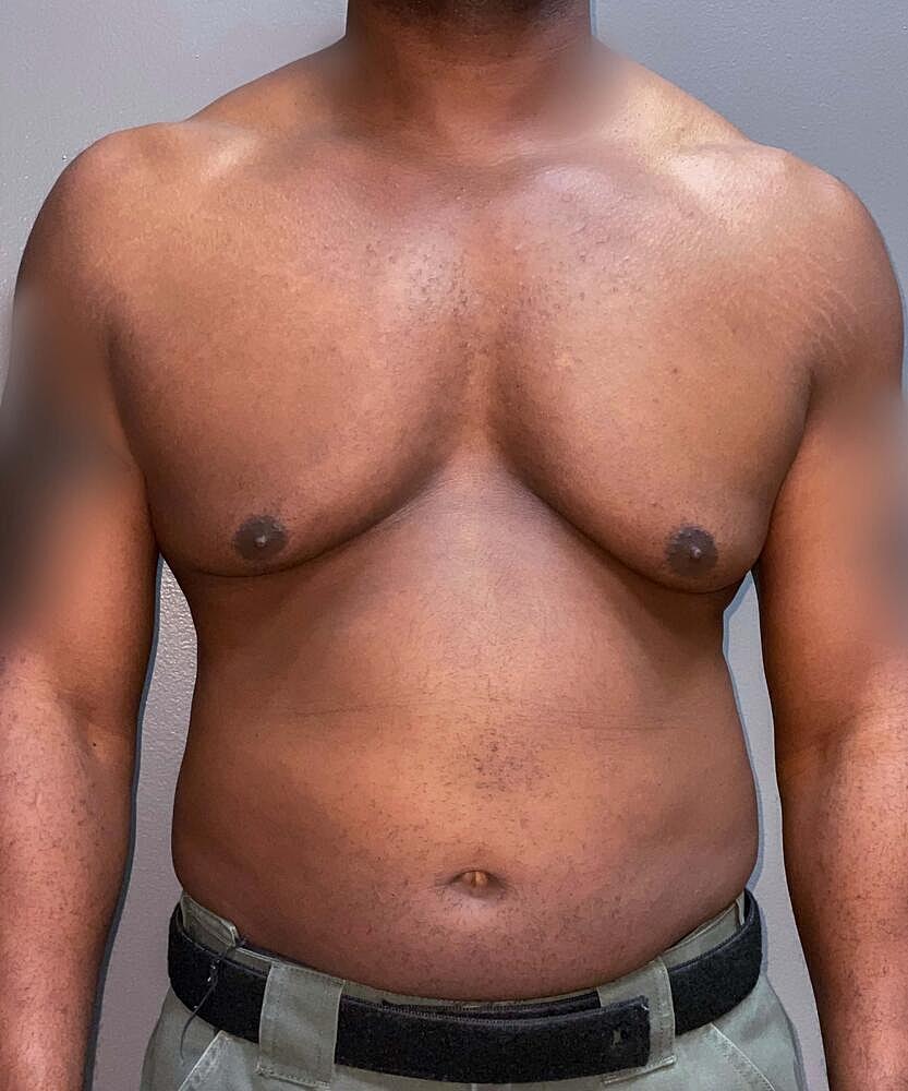 Gynecomastectomy Before & After