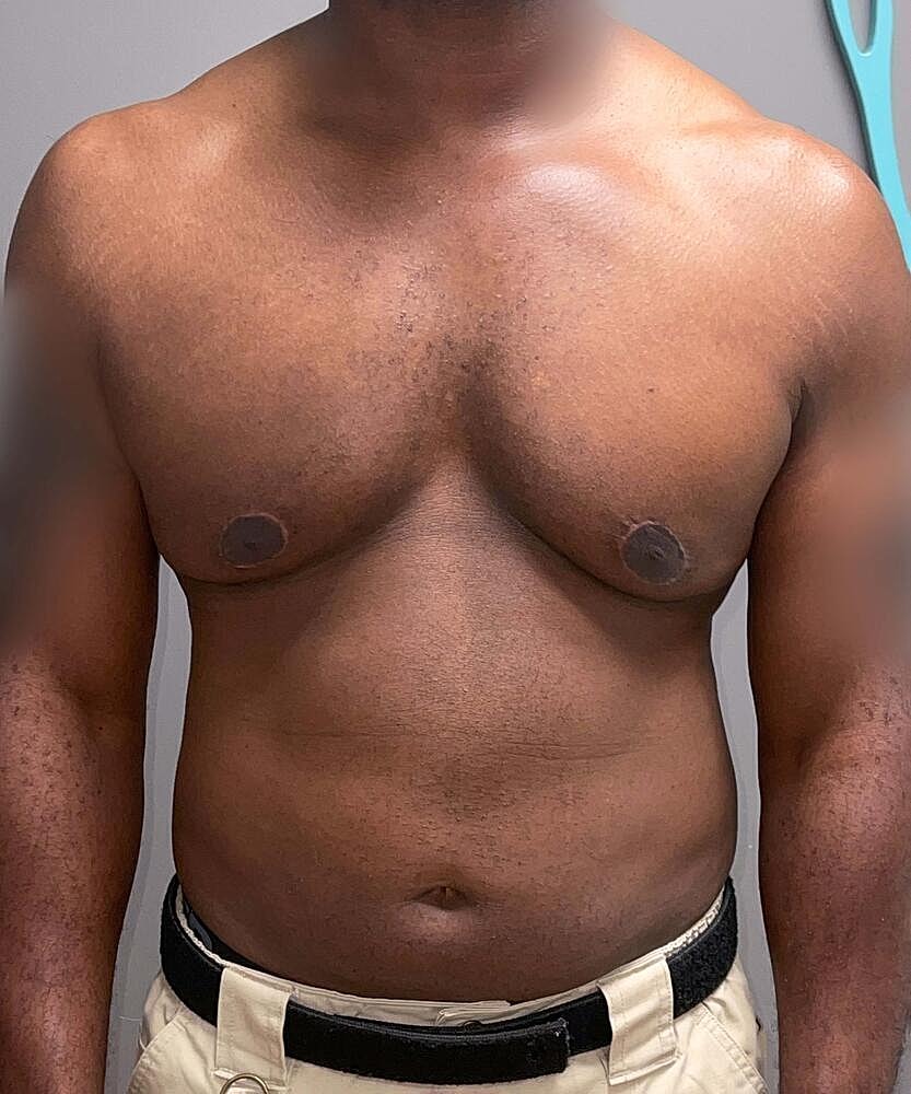 Gynecomastectomy Before & After