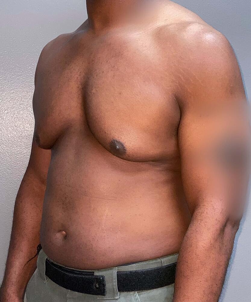 Gynecomastectomy Before & After