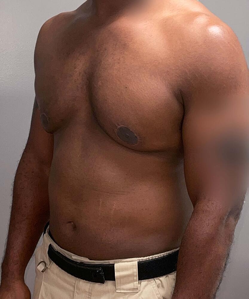 Gynecomastectomy Before & After