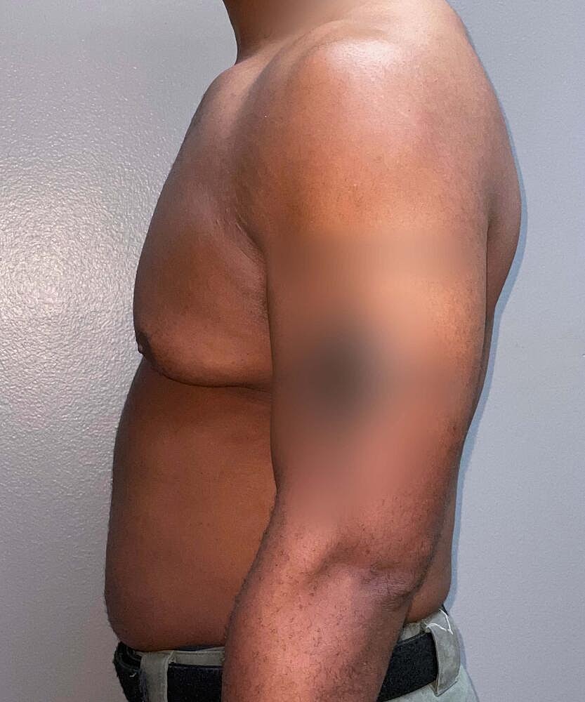 Gynecomastectomy Before & After