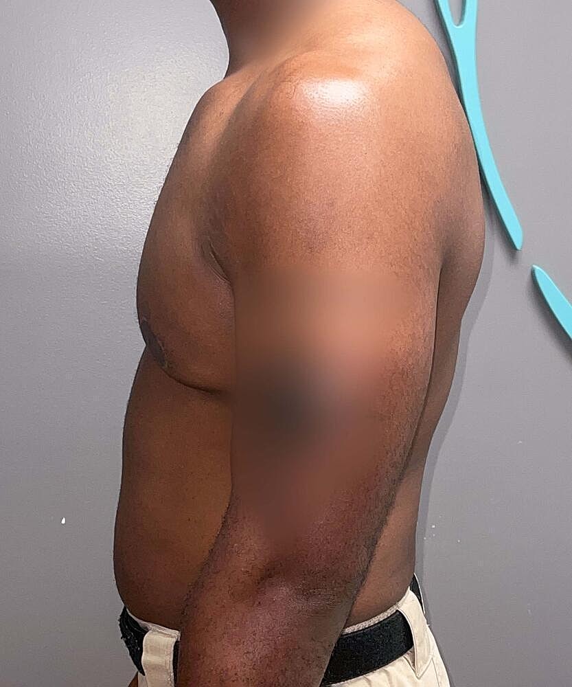 Gynecomastectomy Before & After
