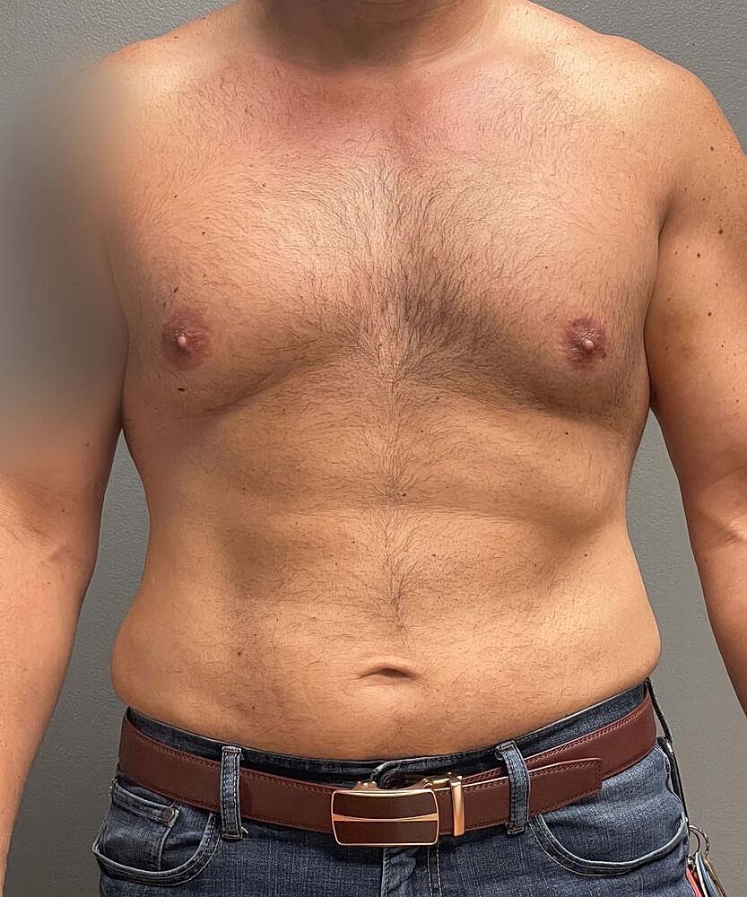 Gynecomastectomy Before & After