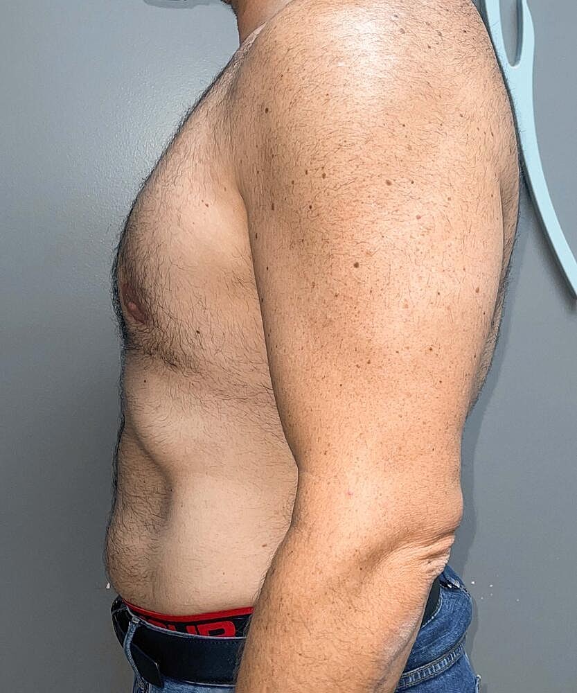 Gynecomastectomy Before & After