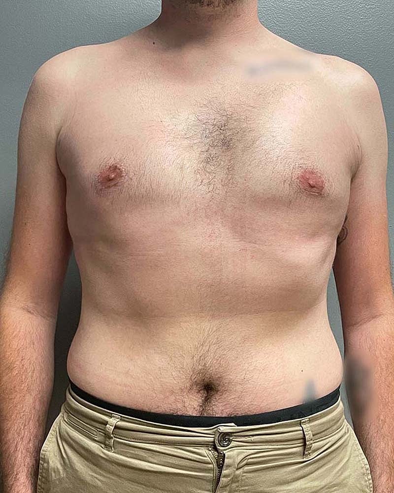 Gynecomastectomy Before & After